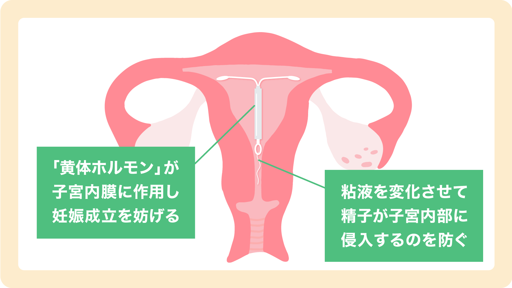 ミレーナが挿入されてる子宮とミレーナ解説した図