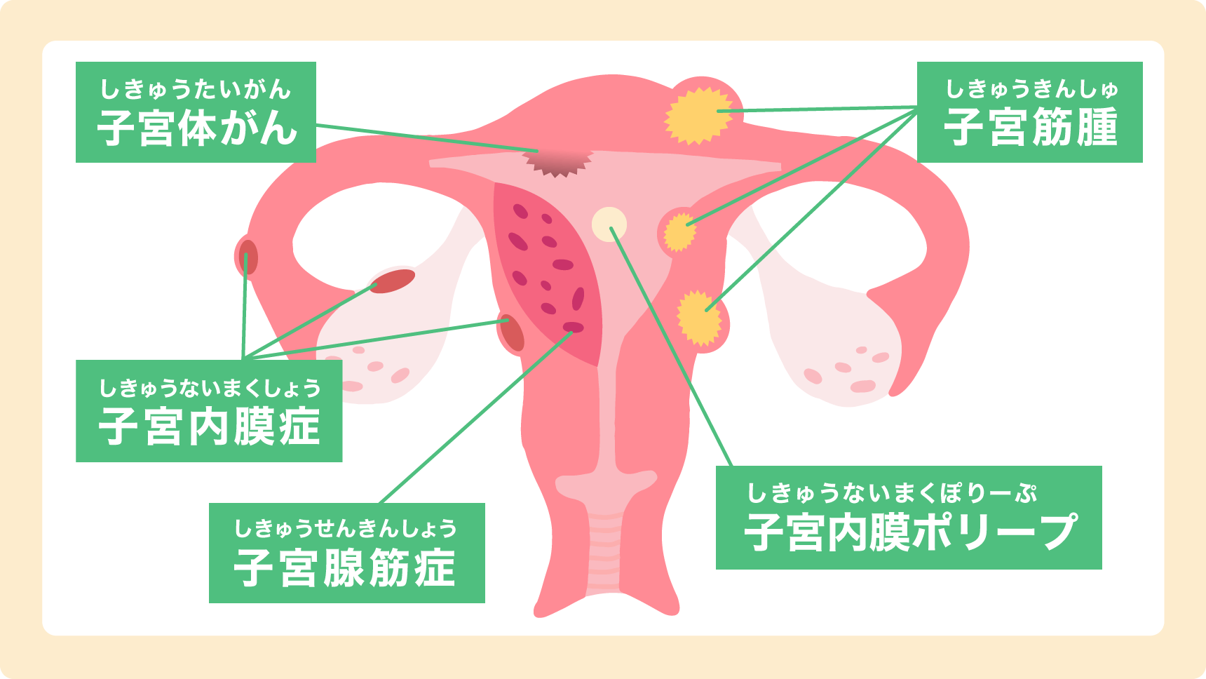 子宮の病気を解説したイラスト