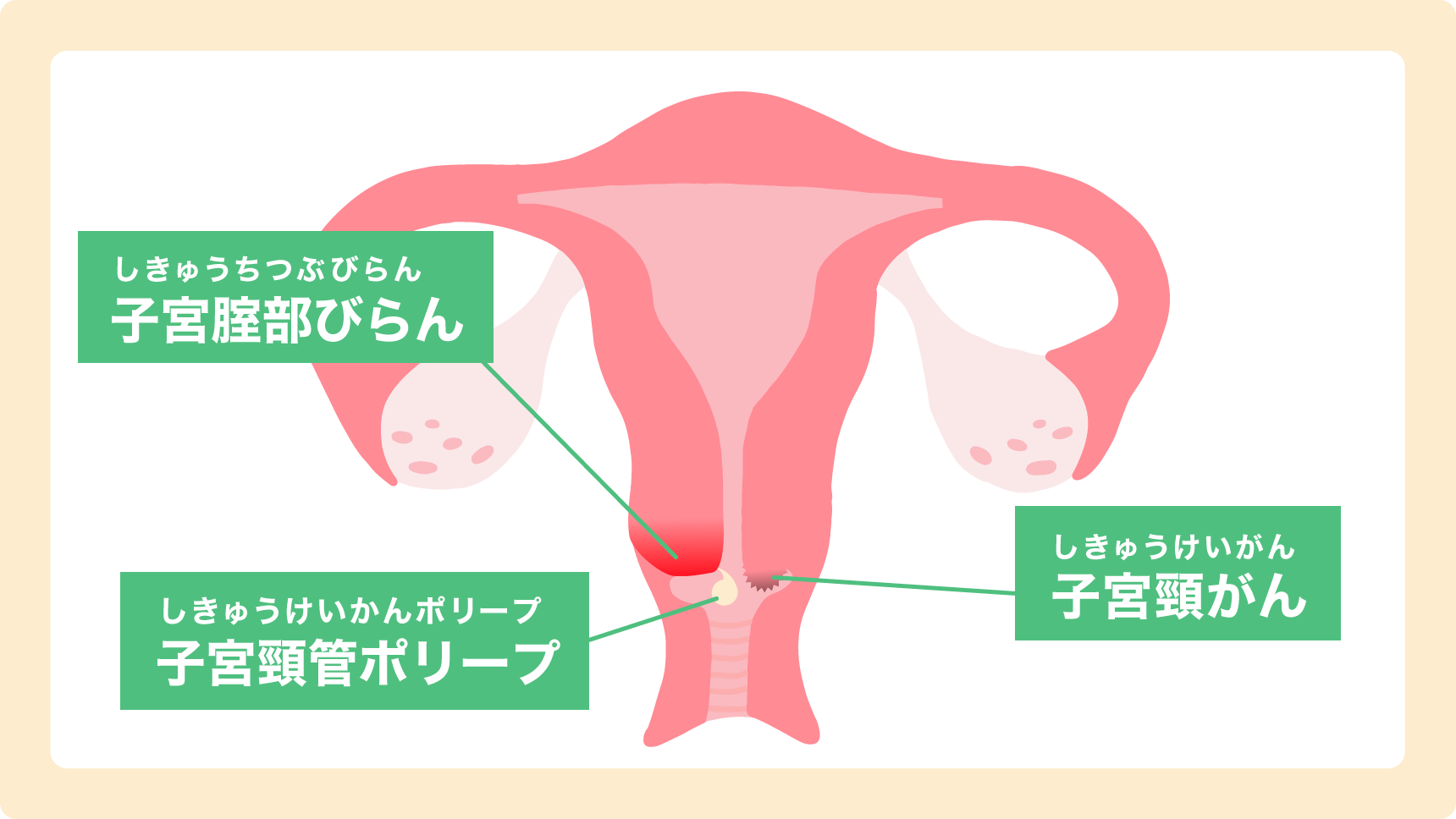 腟の病気の図