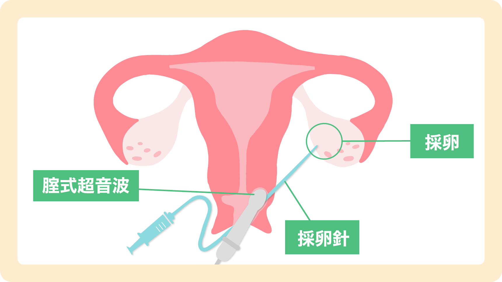 卵子採卵の図