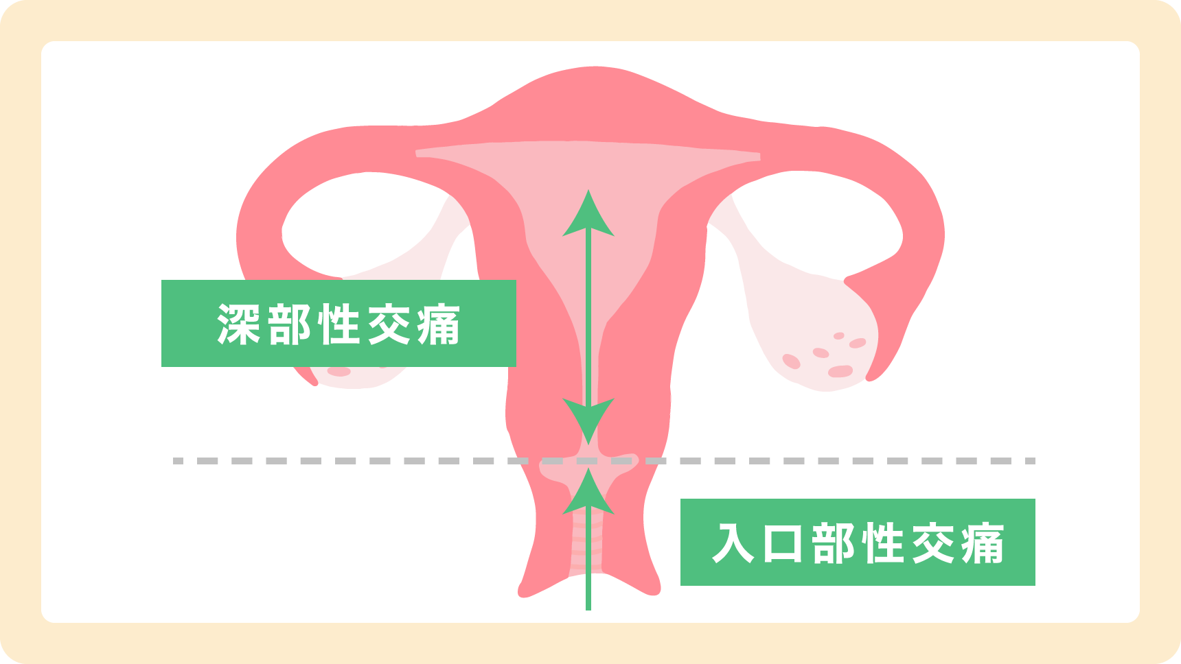 性交痛の痛む箇所の図